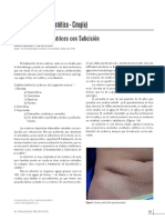 004 - Subcision - Retracciones Cicatrizales