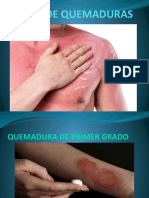 Tipos de Quemaduras