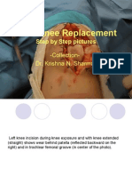 Step by Step Total Knee Replacement Arthroplasty DR Krishna N Sharma