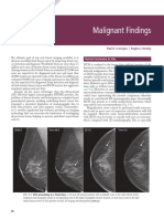 Malignant Findings: Ductal Carcinoma in Situ