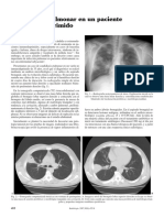 Candidiasis Pulmonar en Un Paciente No Inmunodeprimido: Sr. Director de Radiología