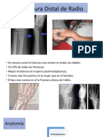 Fractura Distal de Radio