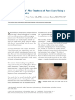 Tram Track Effect - After Treatment of Acne Scars Using A Microneedling Device