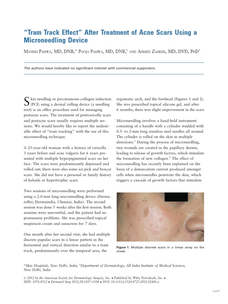 Tram Track Effect After Treatment of Acne Scars Using A Microneedling