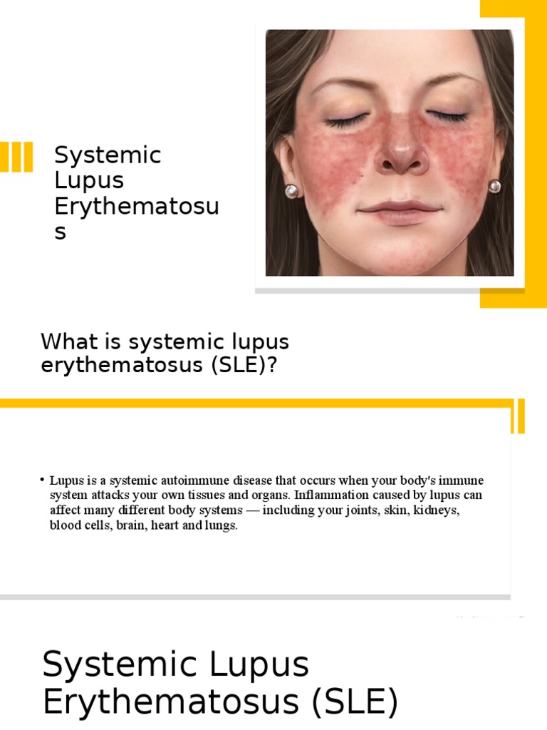 Systemic Lupus Erythematosus PDF Systemic Lupus Erythematosus Immunology