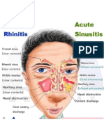 Allergic Rhinitis Vs Acute Sinusitis