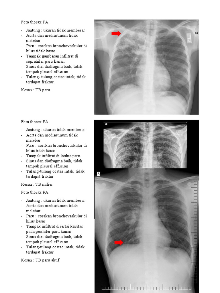 Gambaran Infiltrat Paru pada Foto Thorax | PDF