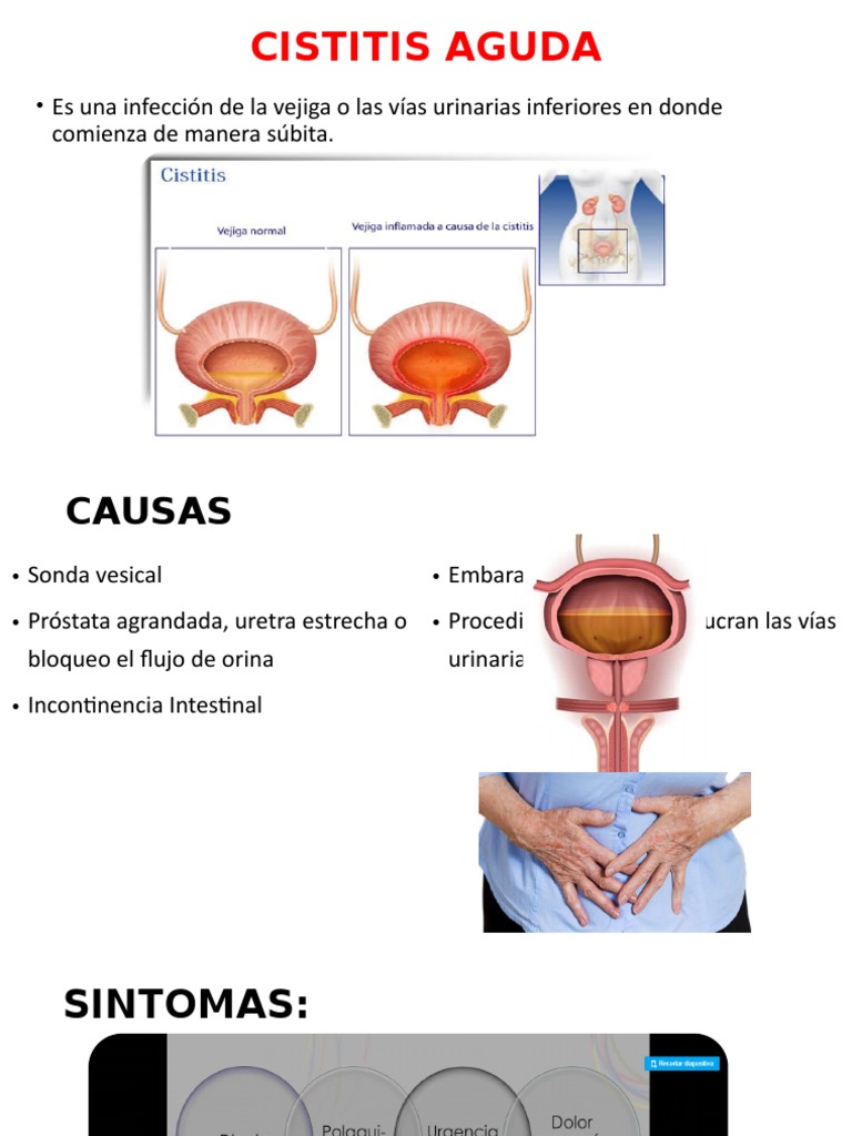 Cistitis Aguda