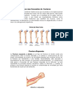 Tipos mas frecuentes de  fractuas.docx