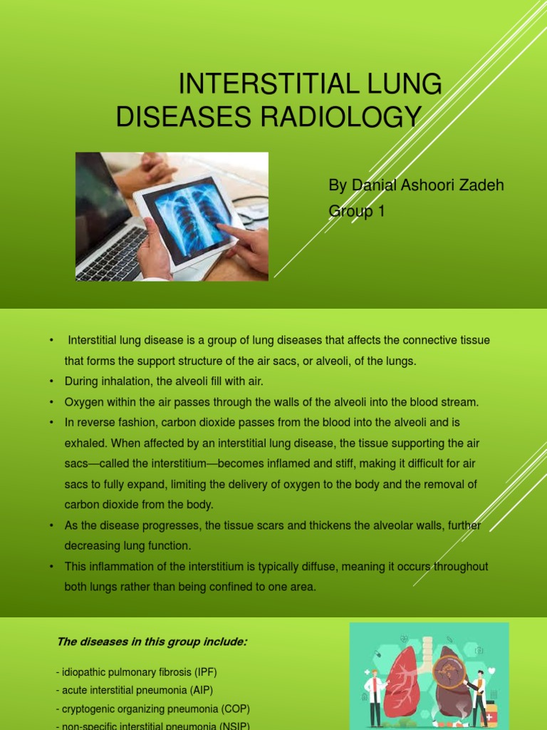 Interstitial Lung Diseases Radiology 22222 PDF Lung Ct Scan