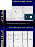 Sindromul de Preexcitatie Ventricular A