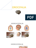 HIDROCEFALIA