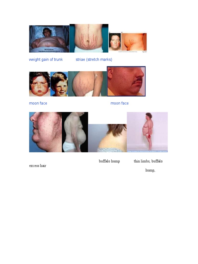 Cushing Syndrome: Moon Face & Buffalo Hump | PDF