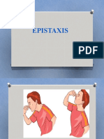 Epistaxis.pptx