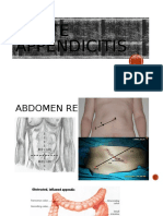 Acute Appendicitis