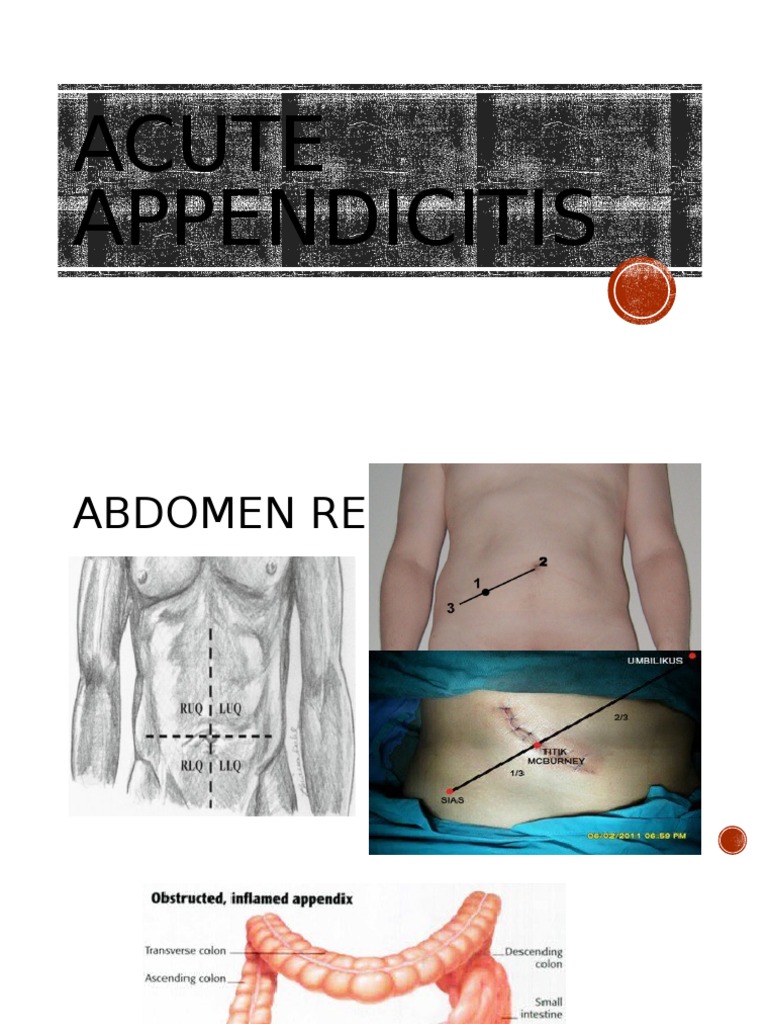 Acute Appendicitis | PDF