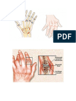 Askep Rheumatoid Arthritis