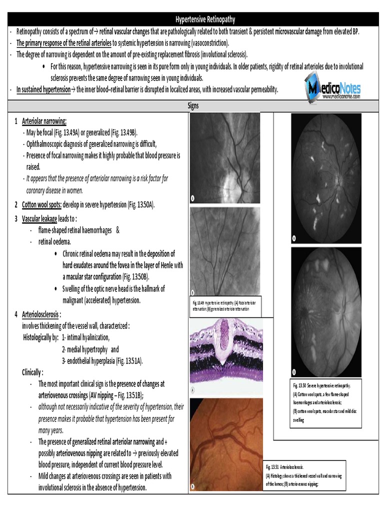 Fig. 13.49 Hypertensive Retinopathy. (A) Focal Arteriolar | PDF | Blood ...