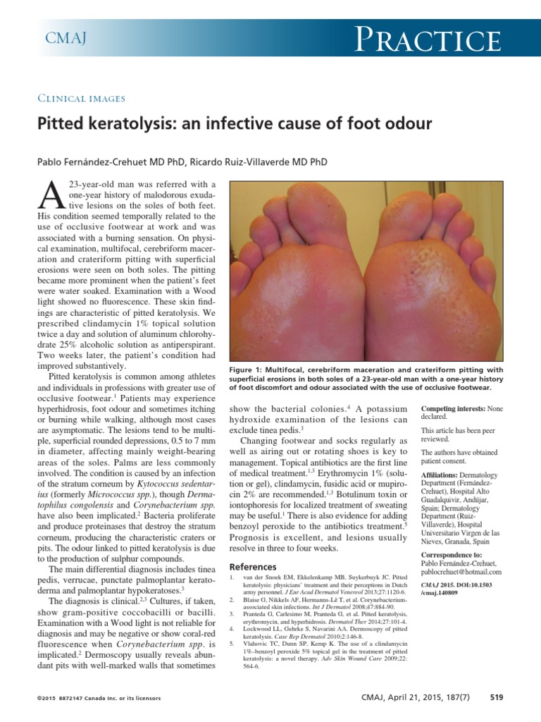 Keratolyse Ponctuee Foot 1870519 Download Free PDF Dermatology — free download