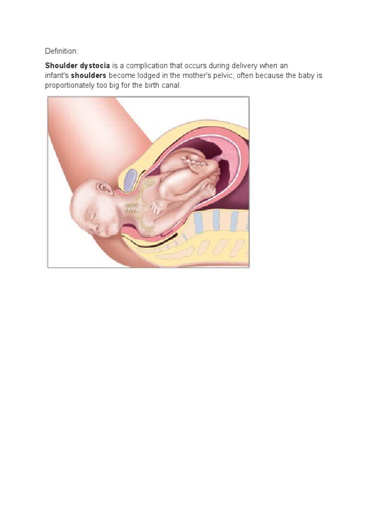 SHOULDER DYSTOCIA intelligence overview