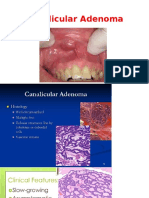 4 Canalicular Adenoma