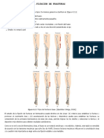 Fijación de fracturas óseas: tipos, factores biomecánicos y métodos