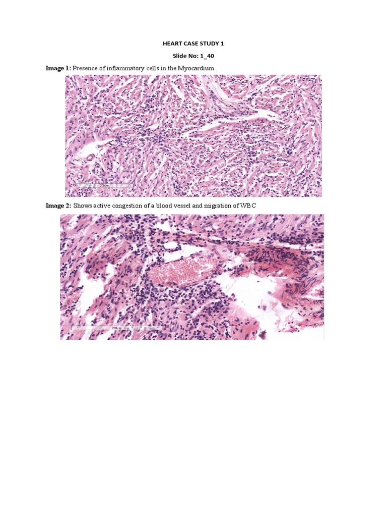 Heart Disease Case Study Analysis | PDF