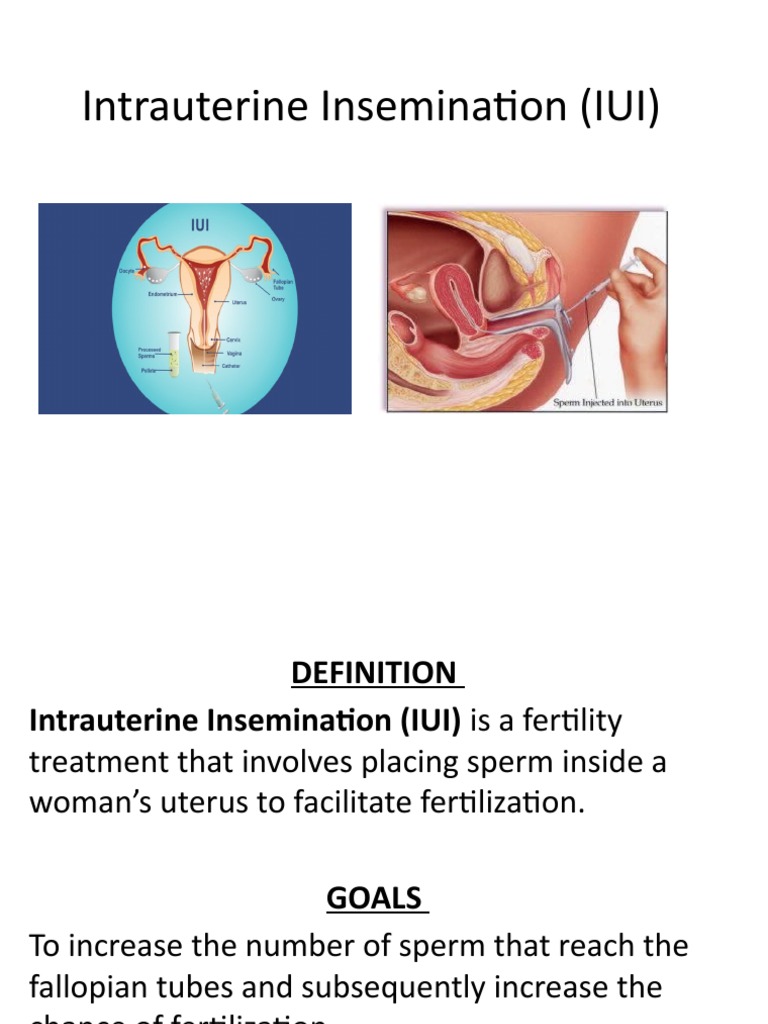 Ivf Iui