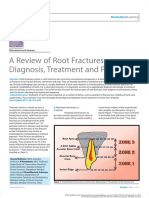 A Review of Root Fractures: Diagnosis, Treatment and Prognosis