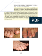 Acute Acro-Ischemia in The Child at The Time of Covid-19