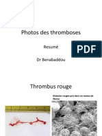 Anapath3an Photos-Thromboses