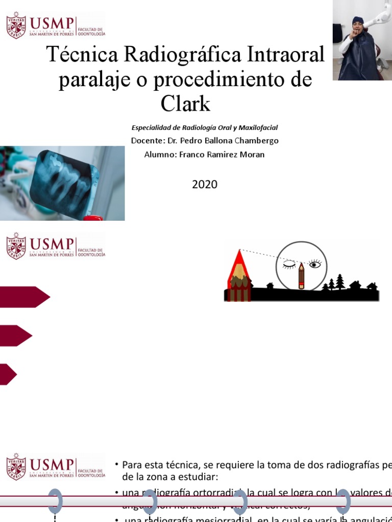 Técnica Radiográfica Intraoral Paralaje o Procedimiento de Clark | PDF
