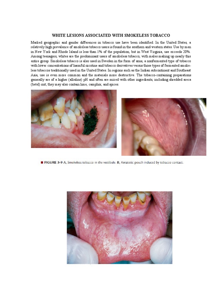 White Lesions Associated With Smokeless Tobacco PDF Immunology