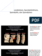 Perbedaan Spondylolysis, Spondylolisthesis, Spondylitis, Dan Spondylosis