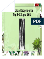 Candida Esophagitis Fig 5-13, PP 161