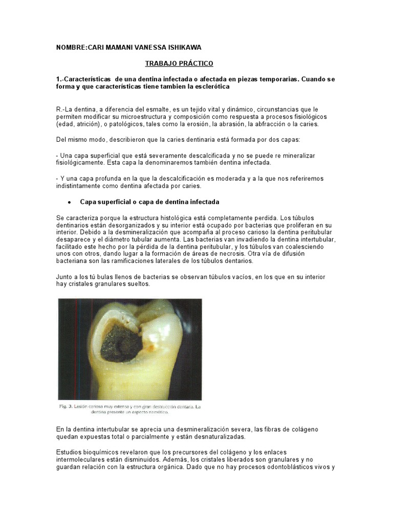 Caracterización de la dentina infectada, afectada y esclerótica y ...