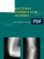 Fracturas Supracondileas de Humero