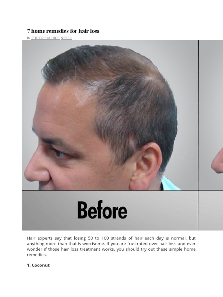 7 Home Remedies For Hair Loss PDF Shampoo Hair Loss