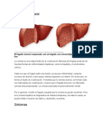 Cirrosis Hepaticaalcoholica