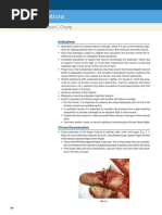 Ray Resections of The Fingers: Indications, Techniques, and Outcomes ...