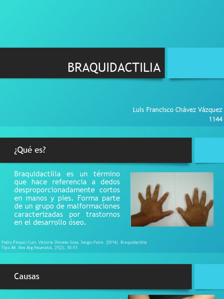 BRAQUIDACTILIA PDF Epidemiología Medicina