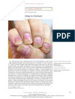 Nail Pitting in Psoriasis: Images in Clinical Medicine