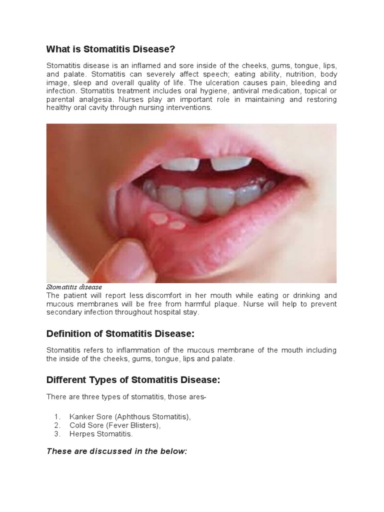 What Is Stomatitis Disease PDF Herpes Simplex Diseases And Disorders
