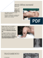 Hemangiomatosis Difusa Neonatal