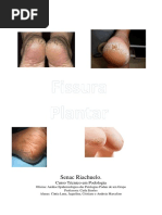 Fissura Plantar