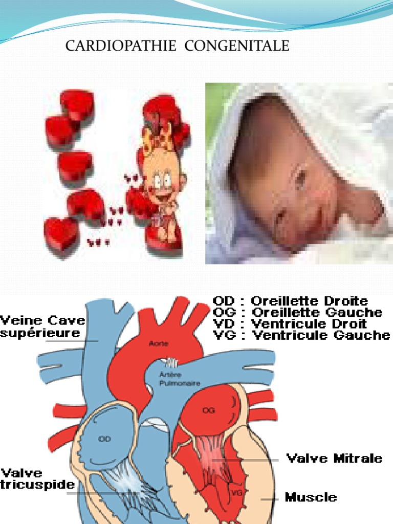 Cardiopathies Congénitales Cours Pdf – QIWS