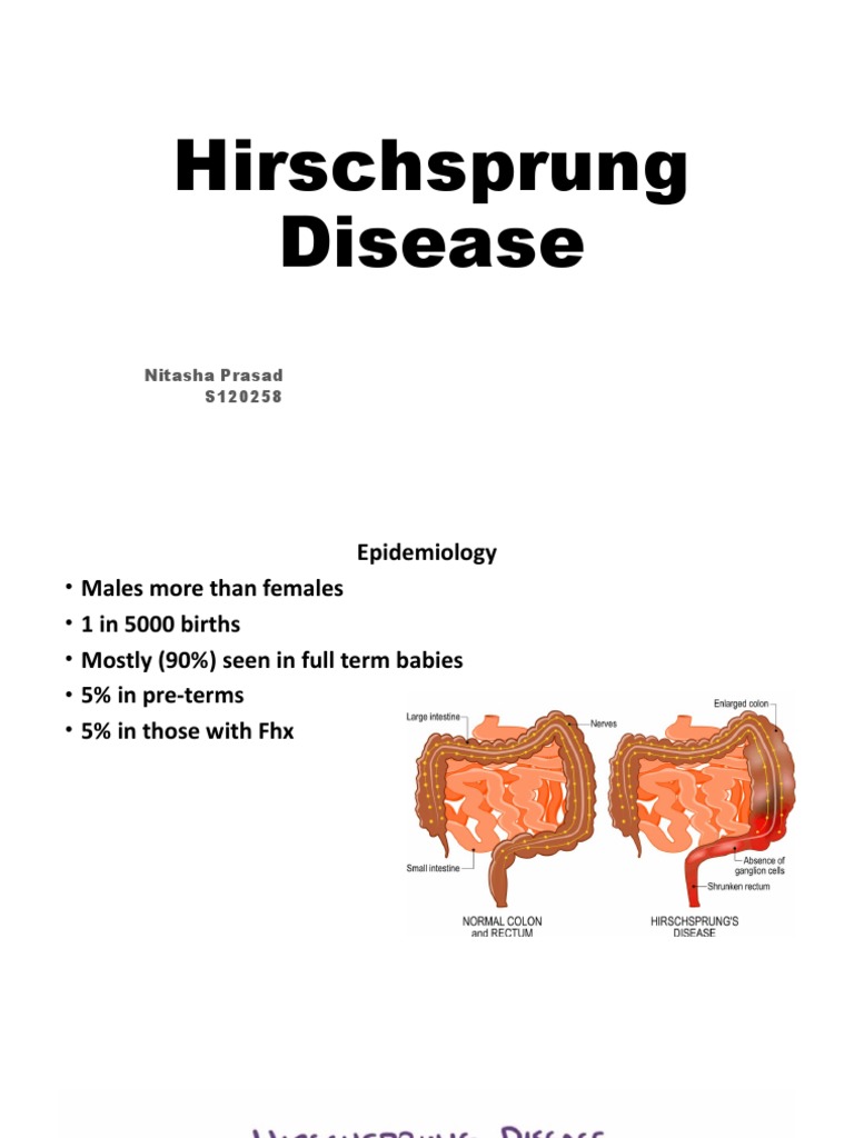 Hirschsprung's Disease Prevalence Chart