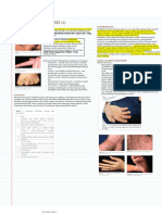 Dishidrosis PDF