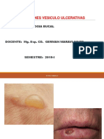 Lesiones vesículo ulcerativas bucales