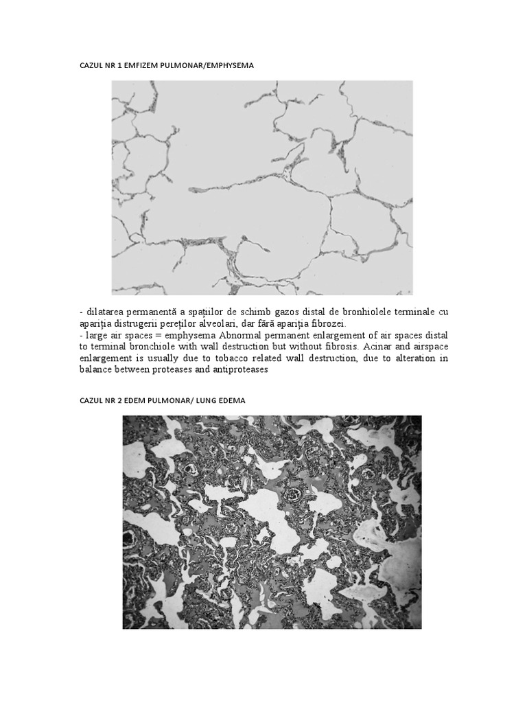 Cazul NR 1 Emfizem Pulmonar/Emphysema | PDF